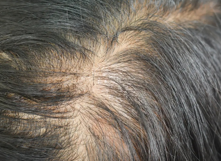Vitamin B5 for Hair Loss.png